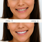 SMILEFIT PRO – SET ADAPTABIL DE DINȚI PENTRU UN ZÂMBET PERFECT